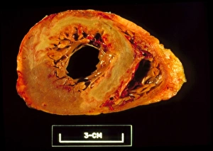 Gross specimen of heart, myocardial infarction Gross specimen of heart, myocardial infarction
