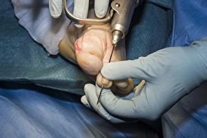 Images Dated 27th January 2014: Hammer Toe Surgery Print