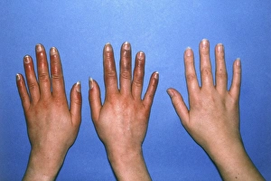 Hands with acrocyanosis compared to healthy hand Hands with acrocyanosis compared to healthy hand