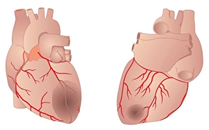 Images Dated 19th May 2011: Heart Damage Print - Computer artwork of a heart muscle with necrotic areas
