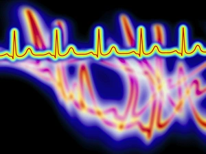 Heart disease: artwork of an irregular ECG trace Heart disease: artwork of an irregular ECG trace