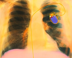 Images Dated 1994: Coloured X-ray Print of a Fitted Heart Pacemaker