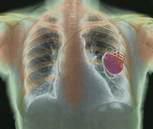 Heart pacemaker, X-ray Heart pacemaker, X-ray