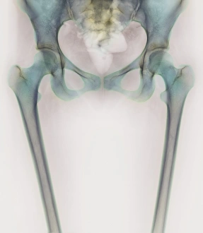 Hip bones, X-ray Hip bones, X-ray
