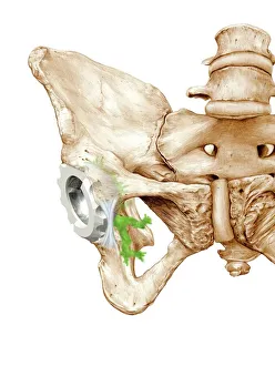 Prints of Hip replacement. Artwork of a prosthetic hip joint socket in a pelvis. The prosthetic femur (thigh bone) head will fit into this socket, forming the hip joint Images Dated 2011 June: Hip Replacement Print: A prosthetic hip joint socket in a pelvis