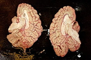 Prints of Human brain dissected in half. A human brain dissected into right and left hemispheres. It has been donated for medical research at the Harvard Brain and Tissue Resource Centre, USA Images Dated 2006 March: Human brain dissected in half, preserved as a print