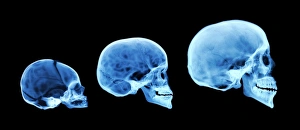 Prints of Human skull development. Coloured x-ray of three human skulls including a newborn, a child and an adult. The newborns skull (left) has a gap in the cranium where the skull plates have not yet sealed Images Dated 2006 April: Human Skull Development Print: Coloured X-ray of Newborn, Child and Adult