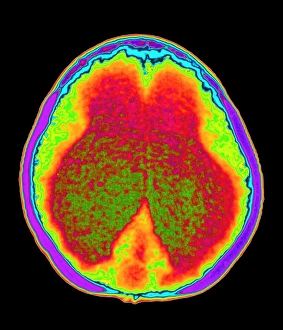Hydrocephalus CT scan Hydrocephalus CT scan