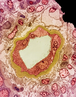 Hydronephrosis Print: Coloured TEM of a human kidney section
