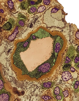 Coloured TEM Images Prints: Hydronephrosis