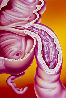Illustration of Crohns disease of the ileum Illustration of Crohns disease of the ileum