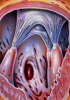Illustration of a ventricular hole in the heart Illustration of a ventricular hole in the heart