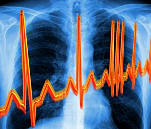 Images Dated 2003: Irregular heartbeat Print: Chest X-ray with electrocardiogram overlay