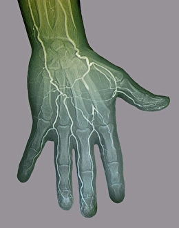 Digital Angiogram Print of Left Hand
