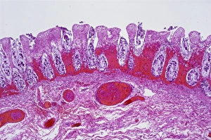 Images Dated 27th March 2013: Ischaemic bowel print, x20 magnification