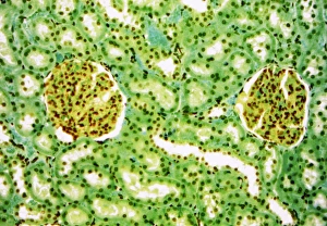 Prints of Kidney glomeruli. Light microscope of a section through the cortex of a healthy kidney showing glomeruli. The core of a glomerulus is formed of a tightly coiled capillary (yellow) Images Dated 2007 October: Kidney Glomeruli Print, x500 magnification