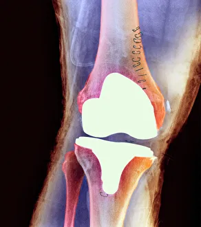 Images Dated 2007: Colour X-ray Print of Knee Joint Prosthesis