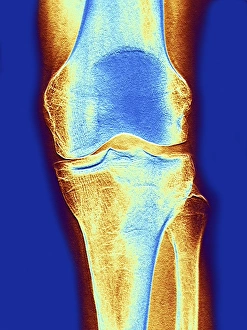 Xray Prints: Colour X-ray Print of the Knee Joint