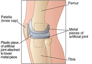 Osteoarthritis Treatment Prints: Knee replacement, artwork