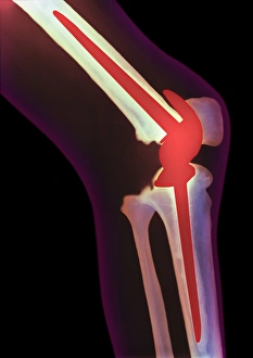 Coloured X-ray Print of Artificial Knee Joint
