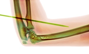 Knitting needle through arm, X-ray F008/3465 Knitting needle through arm, X-ray F008/3465