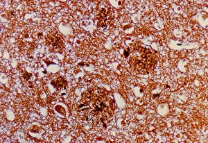 LM of brain tissue affected by Alzheimers disease LM of brain tissue affected by Alzheimers disease