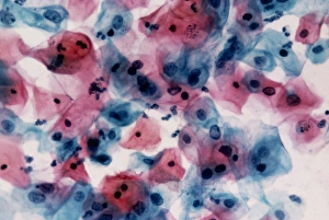 LM of cervical smear cells with mild dyskaryosis LM of cervical smear cells with mild dyskaryosis