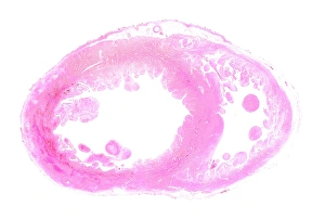 LM of section whole heart showing LV infarct LM of section whole heart showing LV infarct