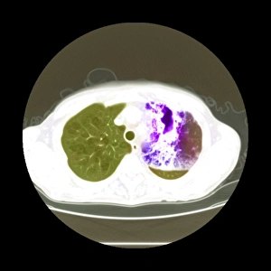 Lung Abscess Print: Coloured CT Scan