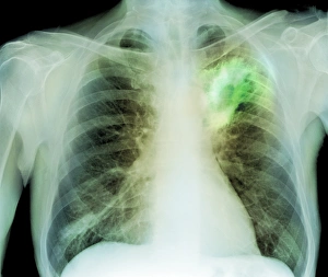 Images Dated 24th September 2010: Lung Abscess Print, Coloured X-ray