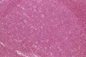 Lymph Node Hyperplasia Print