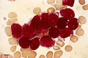 Images Dated 22nd February 2013: Lymphoblastic sarcoma print