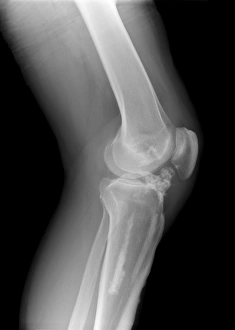 Melorheostosis of the knee, X-ray C017/7145 Melorheostosis of the knee, X-ray C017/7145
