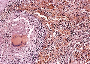 Mycobacterium Tuberculosis Bacteria Prints: Miliary tuberculosis, light micrograph
