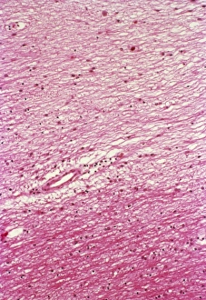 Images Dated 4th March 2013: Multiple Sclerosis Brain Tissue Print