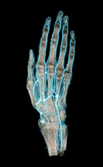 Images Dated 22nd December 2004: Mummified Hand Print: Coloured Angiogram of Embalmed Hand