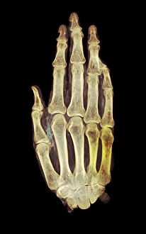 Coloured Medical Imaging Prints: Mummified hand, X-ray