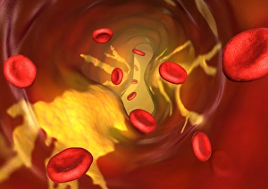 Narrowed Artery Print