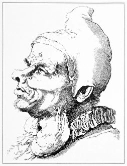 Neurofibromatosis, 17th century artwork Neurofibromatosis, 17th century artwork