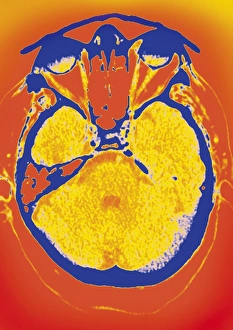 Brain Anatomy Images Prints: Normal brain, CT scan
