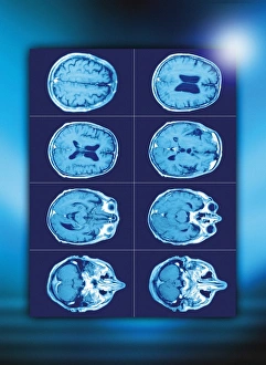 Normal Brain Anatomy Prints: Normal brain, CT scans