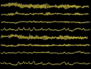 Normal EEG read out of the brains alpha waves Normal EEG read out of the brains alpha waves