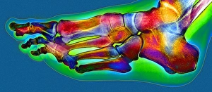 Coloured X-ray Print of a Normal Human Foot