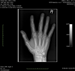 Xray Prints: Digital X-ray Print of a Normal Right Hand