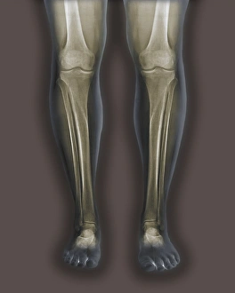 Coloured Frontal X-rays Print of Normal Legs