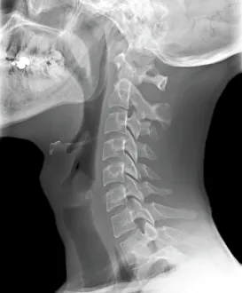 Normal neck, X-ray Print