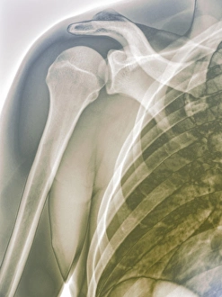 Prints of Normal shoulder. Coloured X-ray of the healthy right shoulder of a 28 year old patient Images Dated 2011 August: Colour X-ray Print of Normal Right Shoulder