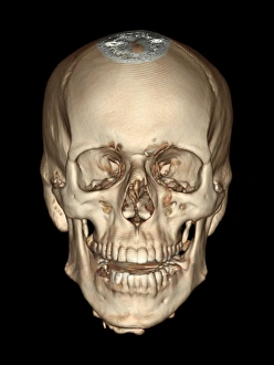 Xray Prints: Normal Skull 3D CT Scan Print