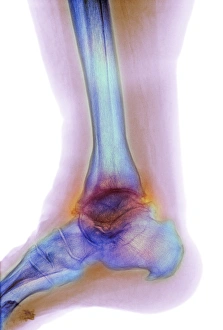 Osteoarthritis of the ankle, X-ray F008/3483 Osteoarthritis of the ankle, X-ray F008/3483