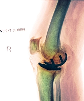 Osteoarthritis of the knee, X-ray F008/3461 Osteoarthritis of the knee, X-ray F008/3461